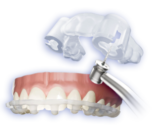 IPS Guided Veneers