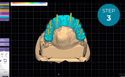 Step3_Reverse_Engineer_Implant_Placement